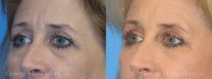 Blepharoplasty Patient 4