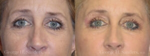 Blepharoplasty Patient 3