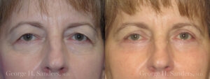 Blepharoplasty Patient 1