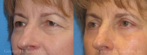 Blepharoplasty Patient 2