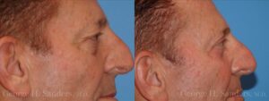 31227-BLEPHAROPLASTY-WITH-LASER.002