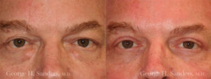 dr-sanders-los-angeles-Eyelid-surgery-male_patient-1-1