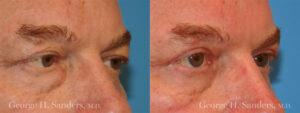 dr-sanders-los-angeles-Eyelid-surgery-male_patient-1-2