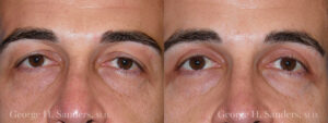 dr-sanders-los-angeles-Eyelid-surgery-male_patient-2-1