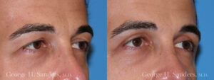 dr-sanders-los-angeles-Eyelid-surgery-male_patient-2-2