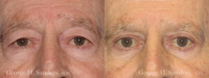 dr-sanders-los-angeles-Eyelid-surgery-male_patient-6-1