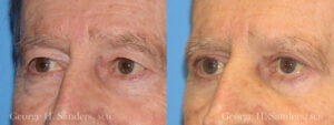 dr-sanders-los-angeles-Eyelid-surgery-male_patient-6-2