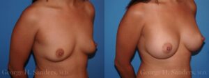 17715-Breast-Augmentation.002