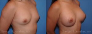 31556-Breast-Augmentation.002