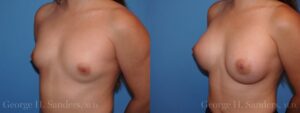 31556-Breast-Augmentation.003