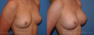 Dr-George-Sanders-Breast-Augmentation_Patient-32985b