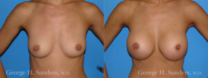 dr-sanders-los-angeles-Breast_augmentation_patient-1-1