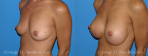 dr-sanders-los-angeles-Breast_augmentation_patient-1-2