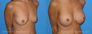 dr-sanders-los-angeles-Breast_augmentation_patient-1-3