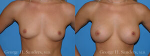 dr-sanders-los-angeles-Breast_augmentation_patient-2-1