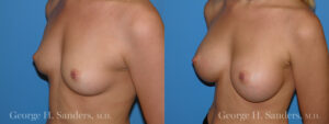 dr-sanders-los-angeles-Breast_augmentation_patient-2-2