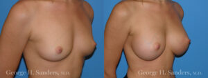 dr-sanders-los-angeles-Breast_augmentation_patient-2-3