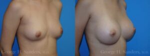 dr-sanders-los-angeles-Breast_augmentation_patient-23-2-1