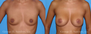 dr-sanders-los-angeles-Breast_augmentation_patient-3-1