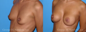 dr-sanders-los-angeles-Breast_augmentation_patient-3-2