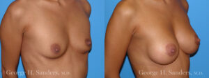 dr-sanders-los-angeles-Breast_augmentation_patient-3-3