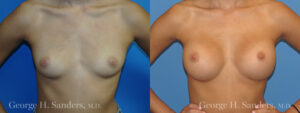 dr-sanders-los-angeles-Breast_augmentation_patient-4-1