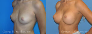 dr-sanders-los-angeles-Breast_augmentation_patient-4-2