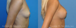 dr-sanders-los-angeles-Breast_augmentation_patient-4-3