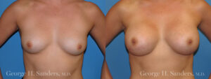 dr-sanders-los-angeles-Breast_augmentation_patient-5-1