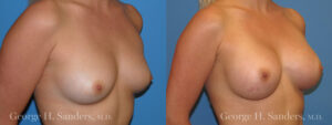 dr-sanders-los-angeles-Breast_augmentation_patient-5-2