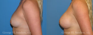 dr-sanders-los-angeles-Breast_augmentation_patient-5-3